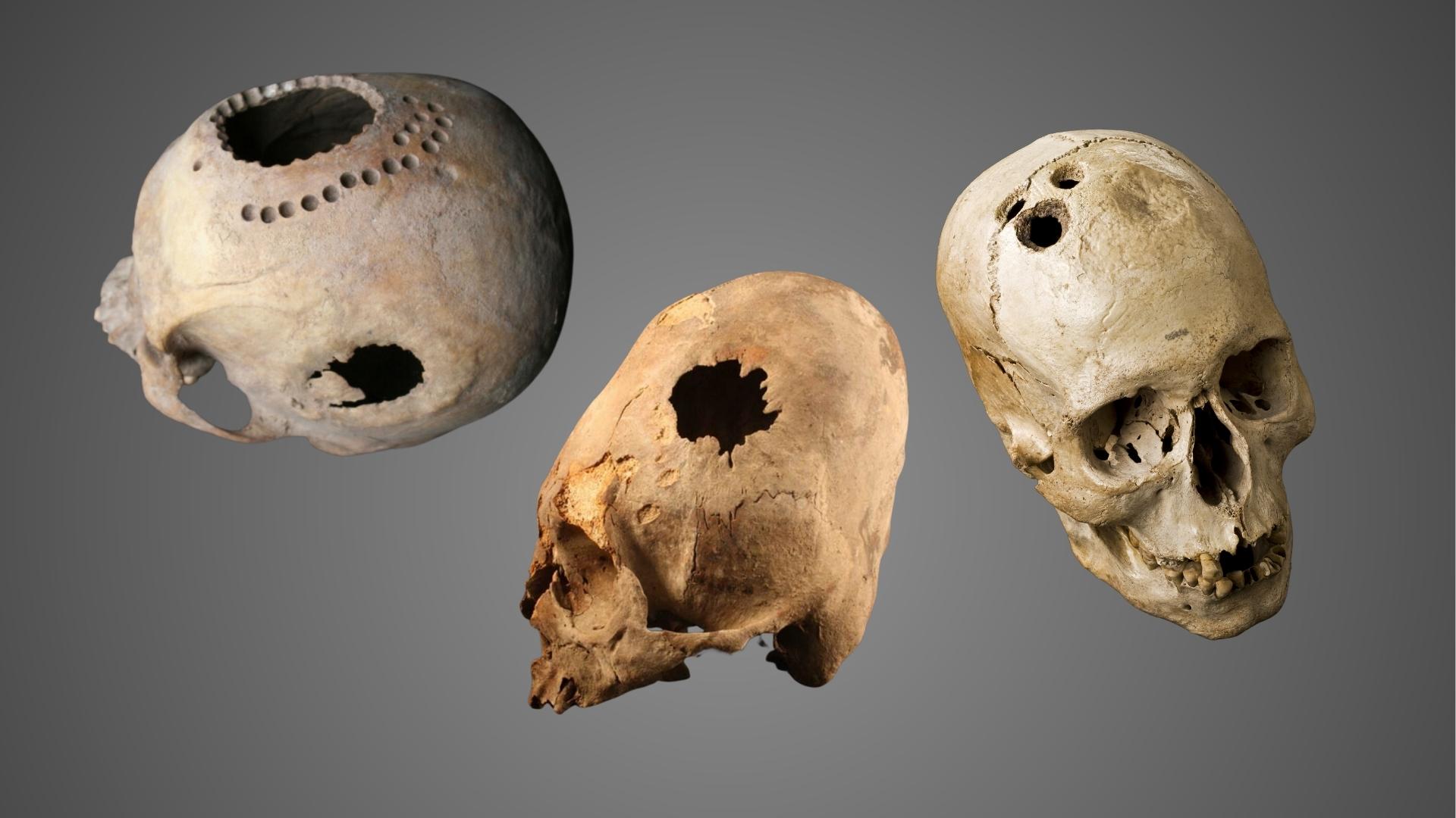 Ancient Brain Surgery: Living with Holes in the Head