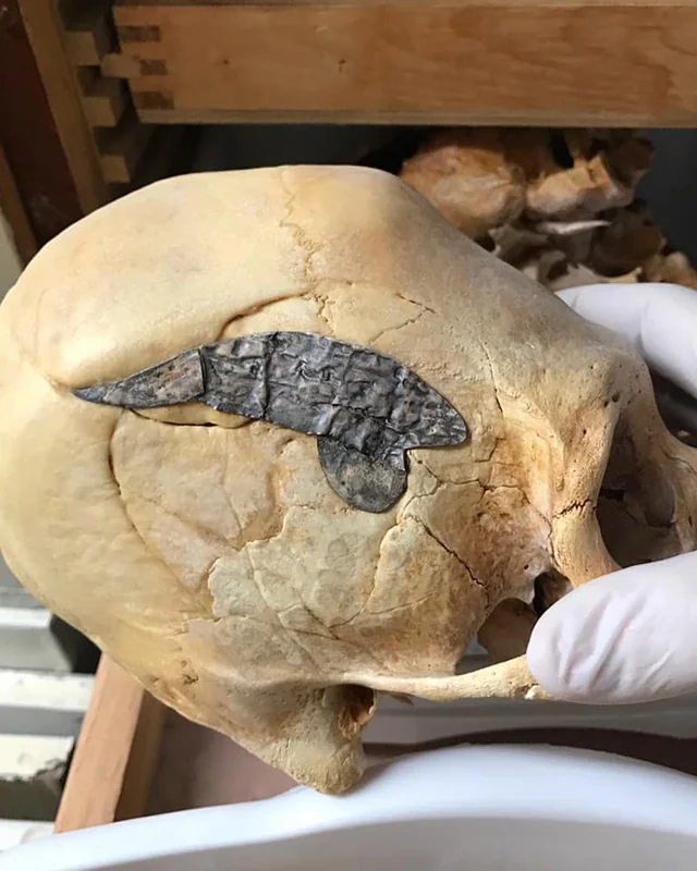 A Peruvian elongated skull, dating back approximately 2000 years, exhibits evidence of successful surgery where metal was surgically implanted after the individual's return from battle. The surrounding broken bone has fused tightly, indicating the surgery's success. | Image Source: Dullahen